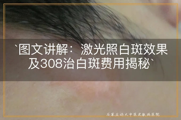 `图文讲解：激光照白斑效果及308治白斑费用揭秘`