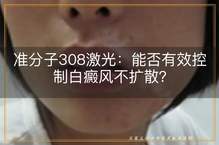 准分子308激光：能否有效控制白癜风不扩散？