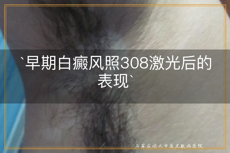 `早期白癜风照308激光后的表现`