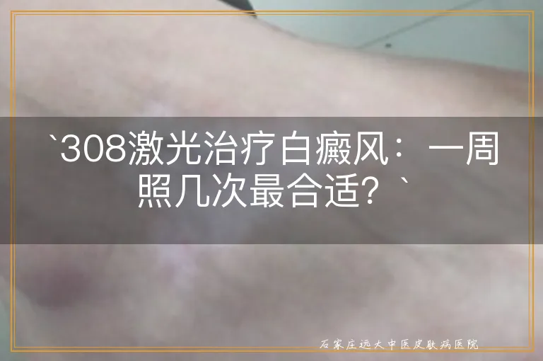 `308激光治疗白癜风：一周照几次最合适？`