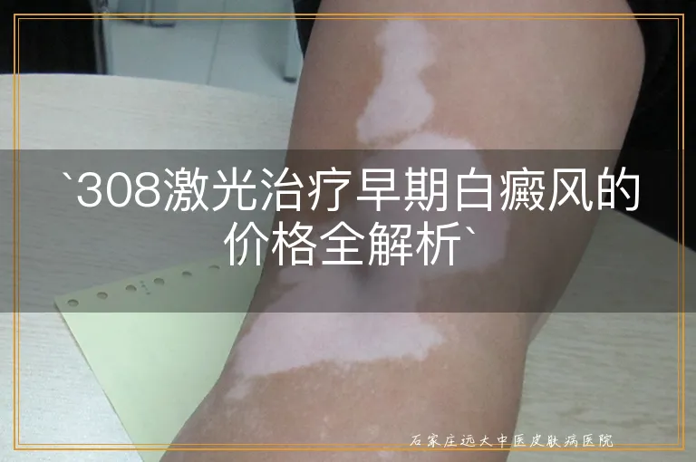 `308激光治疗早期白癜风的价格全解析`