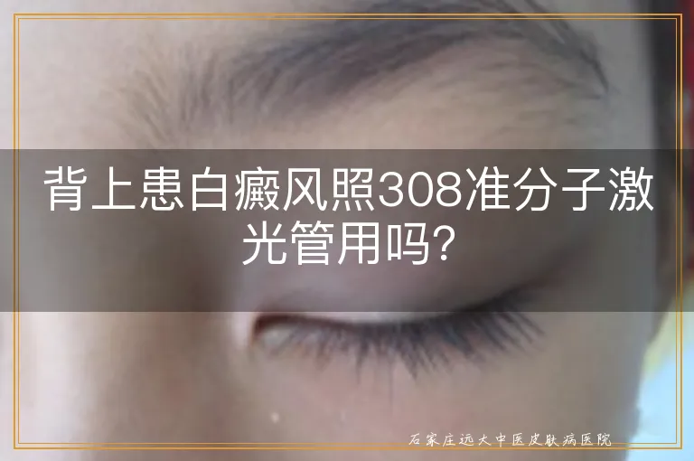 背上患白癜风照308准分子激光管用吗？