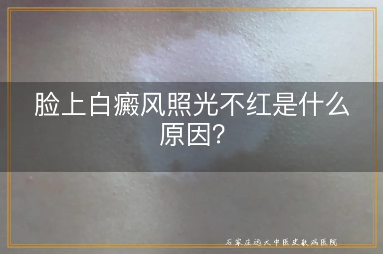 脸上白癜风照光不红是什么原因？