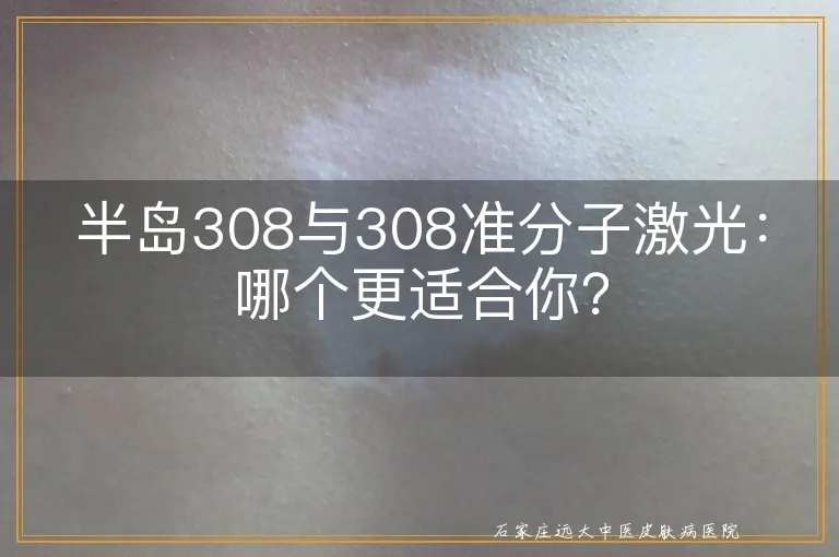 半岛308与308准分子激光：哪个更适合你？