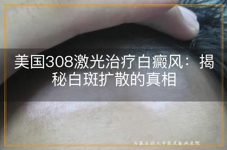 美国308激光治疗白癜风：揭秘白斑扩散的真相