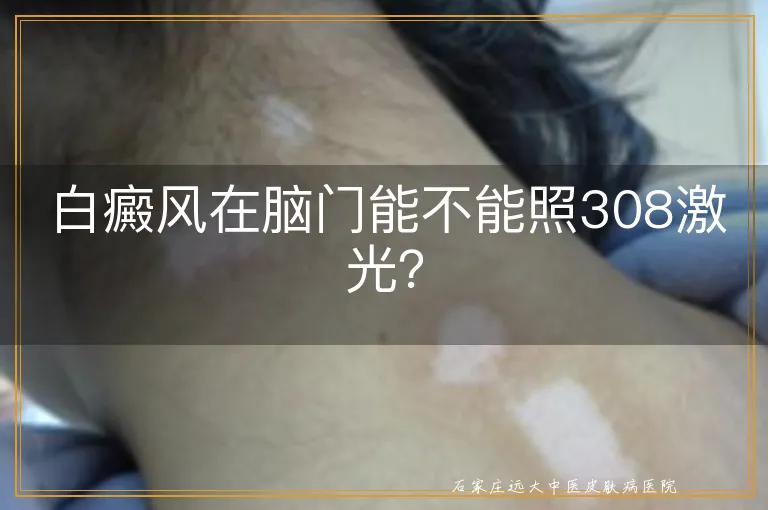 白癜风在脑门能不能照308激光？