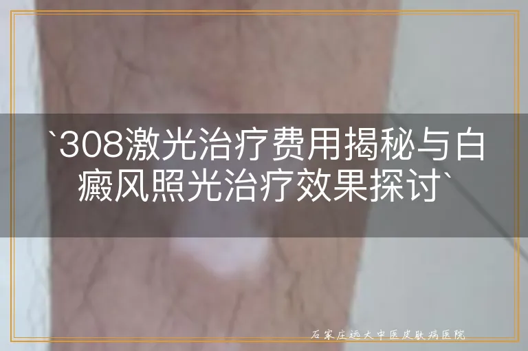 `308激光治疗费用揭秘与白癜风照光治疗效果探讨`