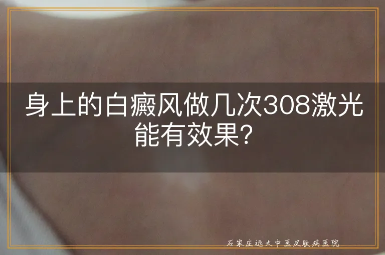 身上的白癜风做几次308激光能有效果？