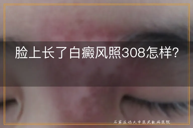 脸上长了白癜风照308怎样？