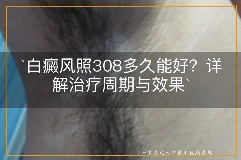 `白癜风照308多久能好？详解治疗周期与效果`