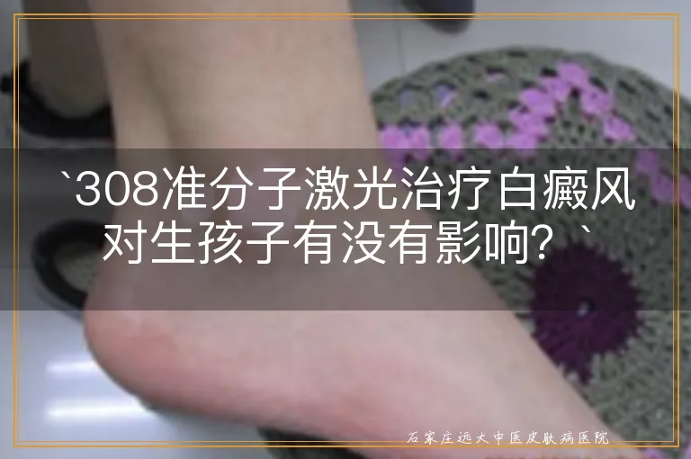 `308准分子激光治疗白癜风对生孩子有没有影响？`