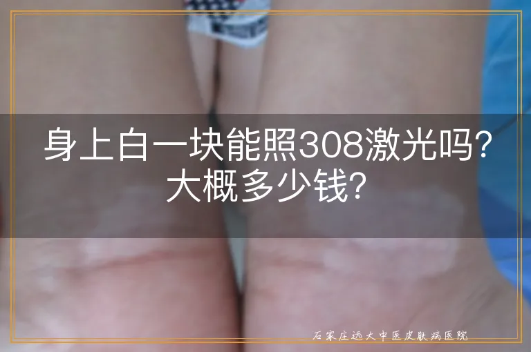 身上白一块能照308激光吗？大概多少钱？