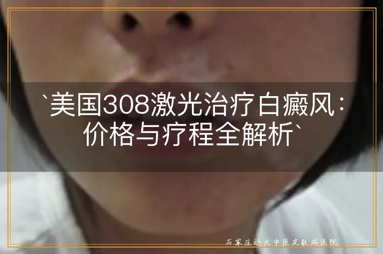 美国308激光治疗白癜风：价格与疗程全解析