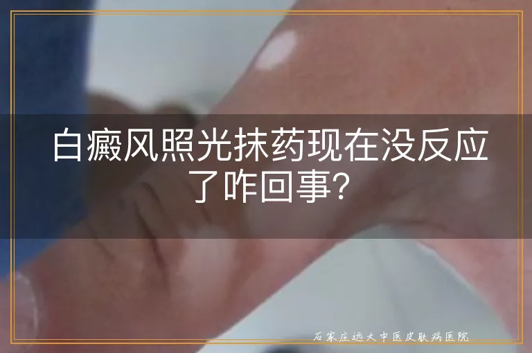 白癜风照光抹药现在没反应了咋回事？