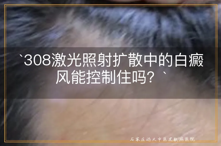 `308激光照射扩散中的白癜风能控制住吗？`