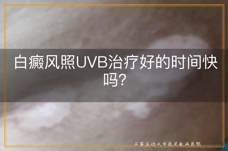 白癜风照UVB治疗好的时间快吗？