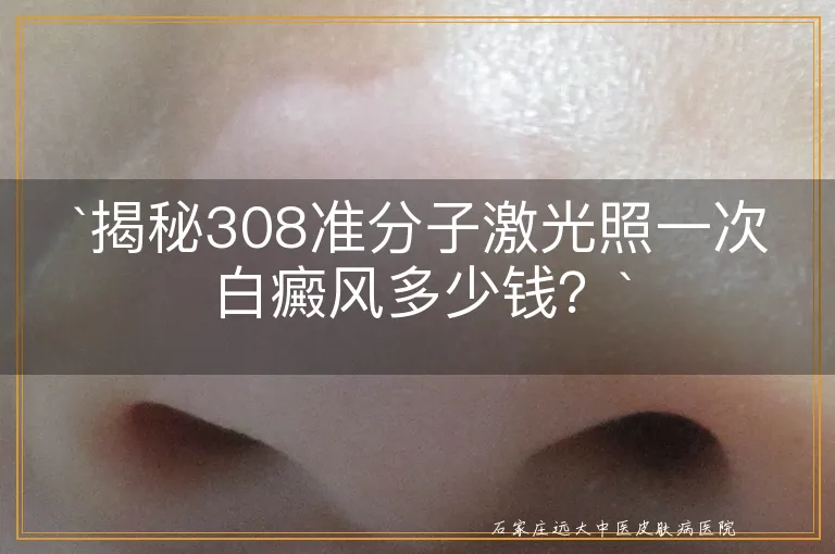 `揭秘308准分子激光照一次白癜风多少钱？`