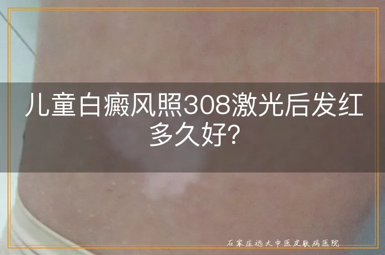 儿童白癜风照308激光后发红多久好？