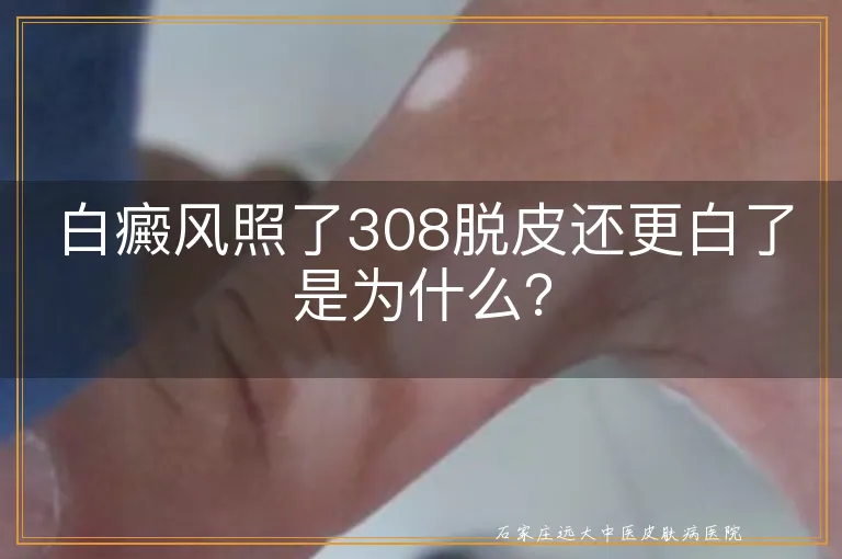 白癜风照了308脱皮还更白了是为什么？