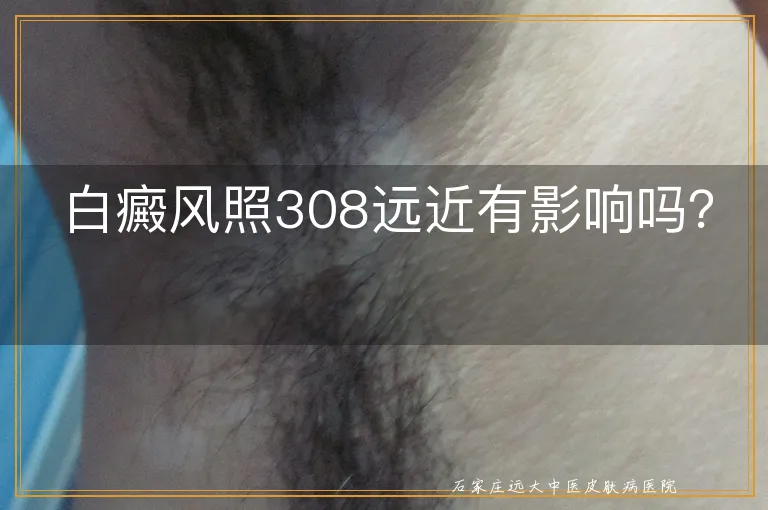 白癜风照308远近有影响吗？