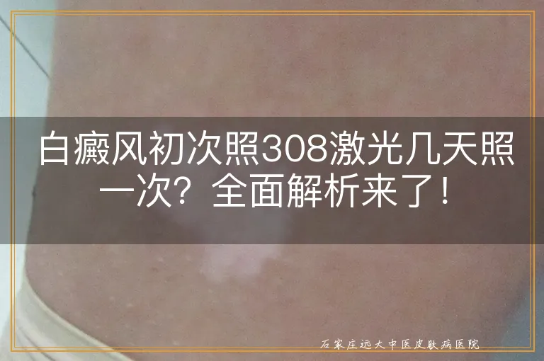 白癜风初次照308激光几天照一次？全面解析来了！