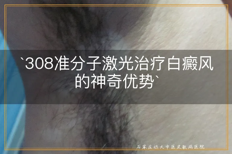 `308准分子激光治疗白癜风的神奇优势`