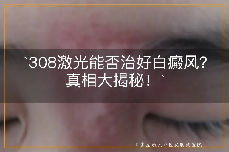 `308激光能否治好白癜风？真相大揭秘！`