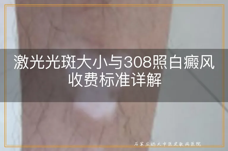 激光光斑大小与308照白癜风收费标准详解