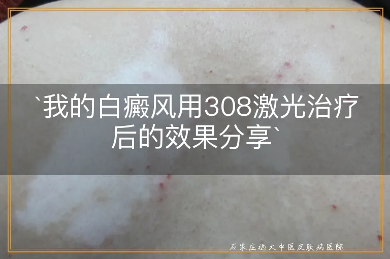 `我的白癜风用308激光治疗后的效果分享`