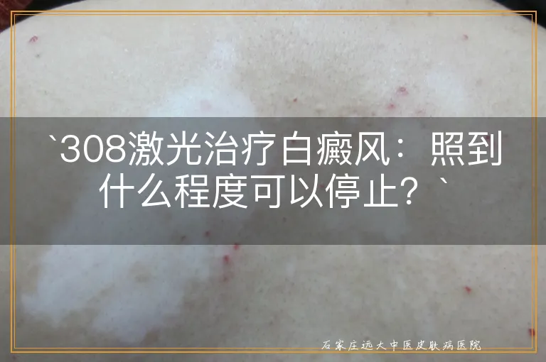 `308激光治疗白癜风：照到什么程度可以停止？`