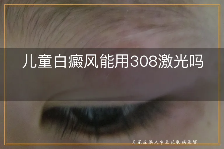 儿童白癜风能用308激光吗