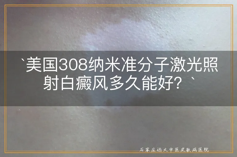 `美国308纳米准分子激光照射白癜风多久能好？`