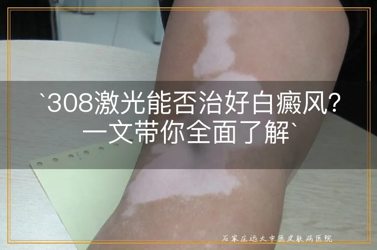 `308激光能否治好白癜风？一文带你全面了解`