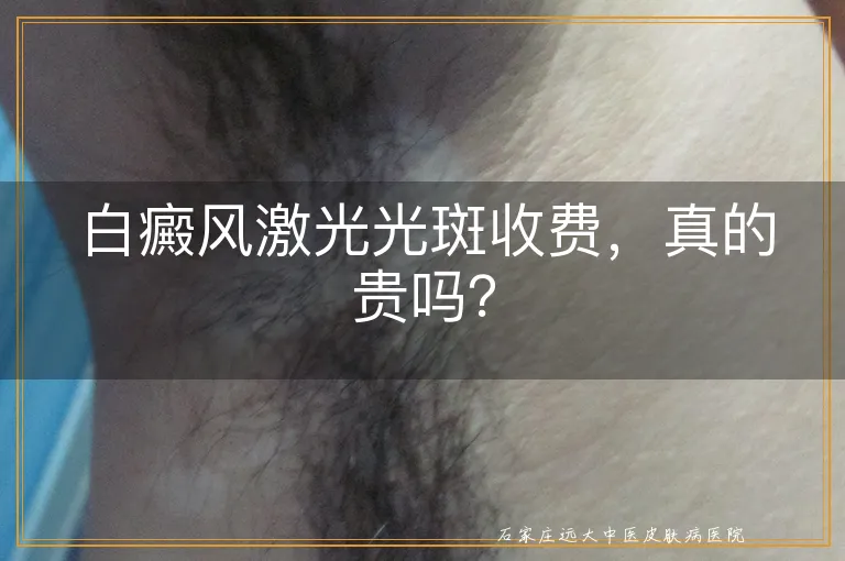 白癜风激光光斑收费，真的贵吗？