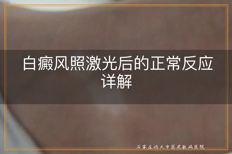 白癜风照激光后的正常反应详解