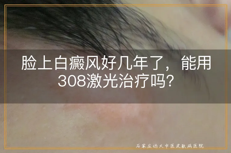 脸上白癜风好几年了，能用308激光治疗吗？