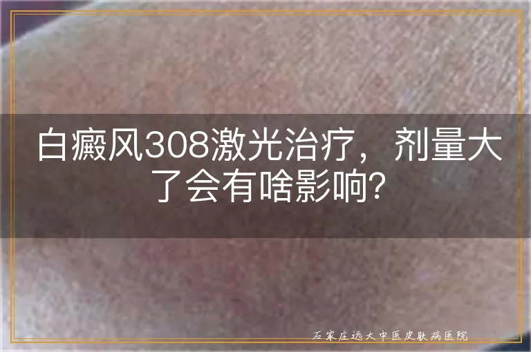 白癜风308激光治疗，剂量大了会有啥影响？