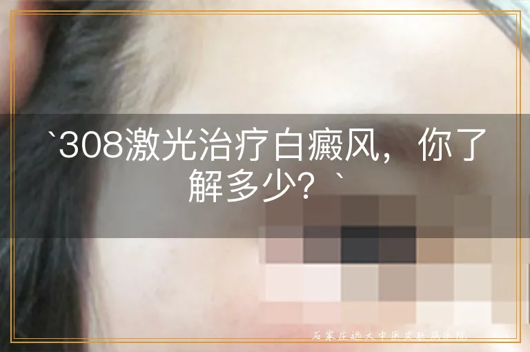 `308激光治疗白癜风，你了解多少？`