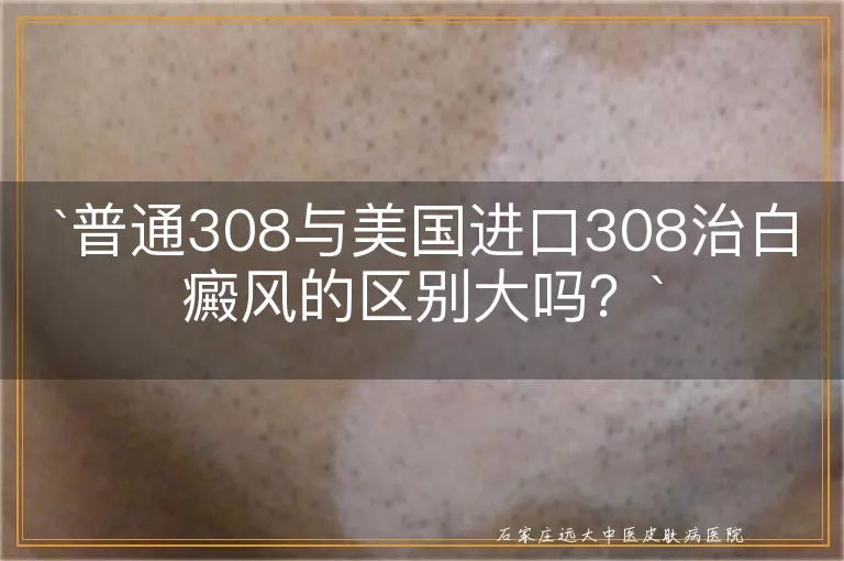 `普通308与美国进口308治白癜风的区别大吗？`