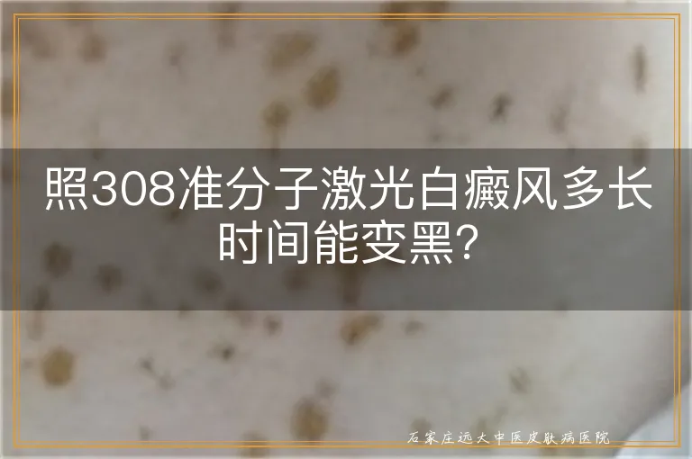 照308准分子激光白癜风多长时间能变黑？