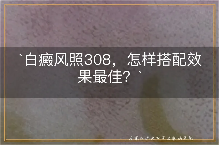 `白癜风照308，怎样搭配效果最佳？`