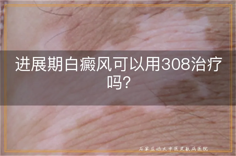 进展期白癜风可以用308治疗吗？