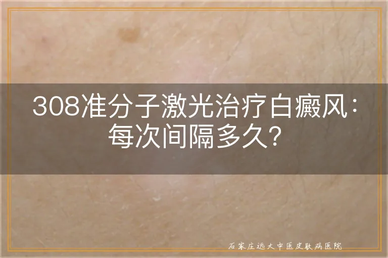 308准分子激光治疗白癜风：每次间隔多久？