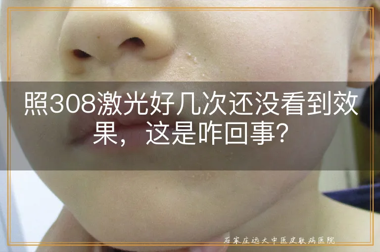 照308激光好几次还没看到效果，这是咋回事？