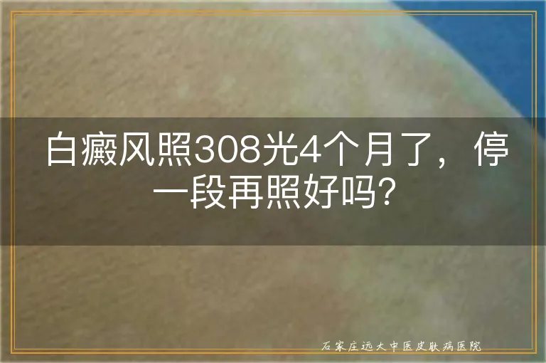 白癜风照308光4个月了，停一段再照好吗？