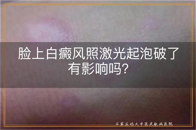 脸上白癜风照激光起泡破了有影响吗？