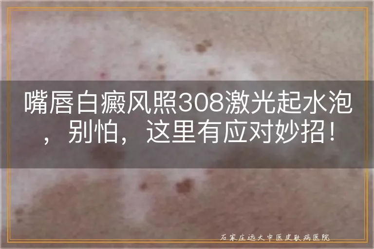 嘴唇白癜风照308激光起水泡，别怕，这里有应对妙招！