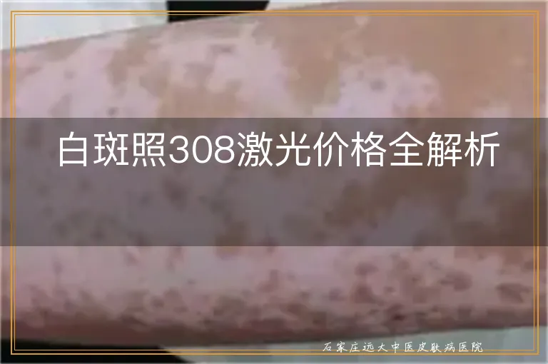 白斑照308激光价格全解析