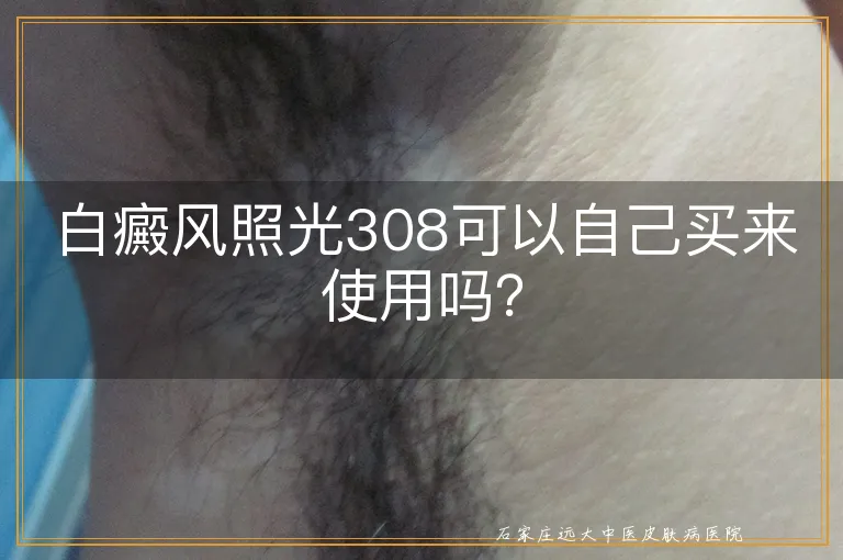 白癜风照光308可以自己买来使用吗？