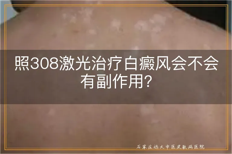 照308激光治疗白癜风会不会有副作用？